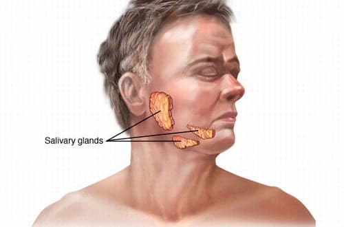 Ung thư tuyến nước bọt là bệnh thường gặp trong các bệnh ung thư vùng đầu cổ