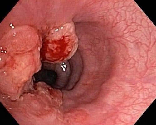 Hình ảnh nội soi dạ dày phát hiện ung thư dạ dày