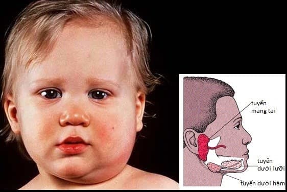 Nguyên nhân bị quai bị là gì?Triệu chứng của bệnh quai bị