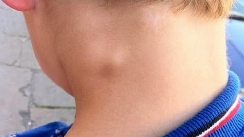 Có nhiều nguyên nhân gây nổi hạch ở cổ