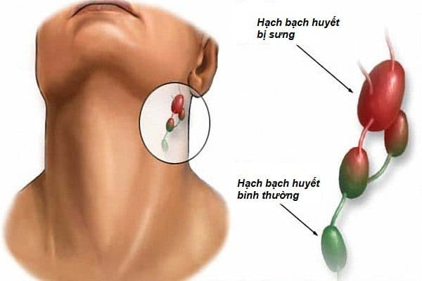 noi-hach-sau-tai-la-benh-gi-2