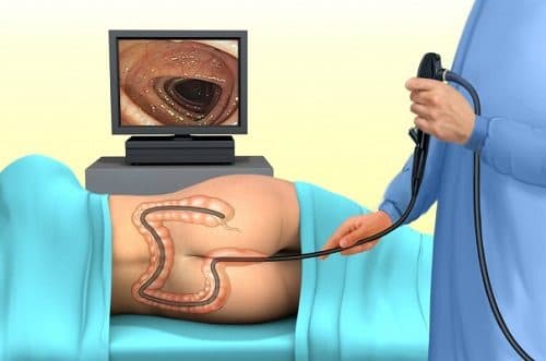 Nội soi đại tràng là phương pháp sử dụng một ống nội soi mềm luồn qua hậu môn vào đại tràng, giúp quan sát toàn bộ đại tràng.