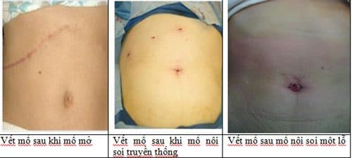 Phương pháp mổ nội soi với vết mổ nhỏ, nhanh lành vết mổ, ít để lại sẹo