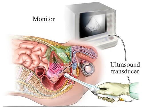 Siêu âm đầu dò có chính xác không là câu thắc mắc của không ít chị em