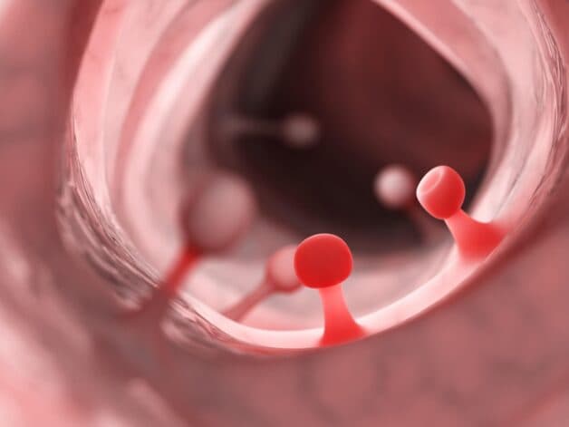 Bệnh lý nguy hiểm nhất có thể khiến trẻ đi ngoài ra máu là Polyp đại tràng.