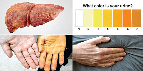 Triệu chứng ung thư gan giai đoạn cuối