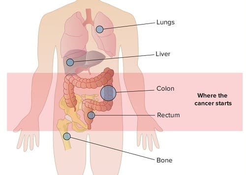 Ung thư tuyến giáp di căn sống được bao lâu?