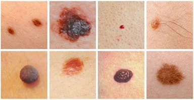 Điều trị ung thư nốt ruồi như thế nào?