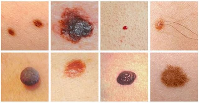 Điều trị ung thư nốt ruồi như thế nào?