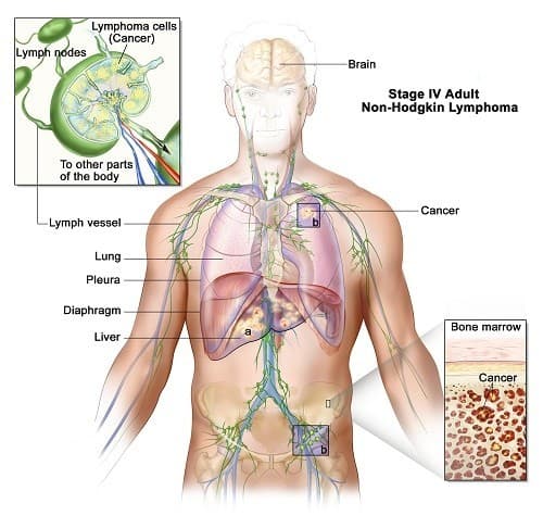 Ung thư hạch có chữa khỏi được không?