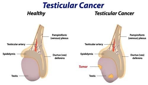 Ung thư tinh hoàn có chữa được không?