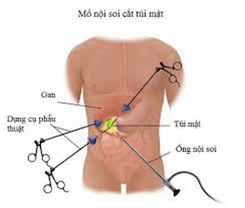 Mổ nội soi sỏi mật là biện pháp điều trị viêm túi mật hiệu quả