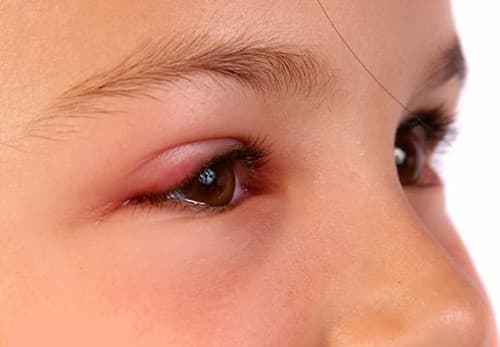 Viêm bờ mi thường có triệu chứng sưng đỏ mi, ghứa tại mi mắt,...