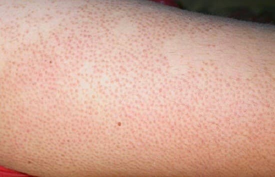 Viêm lỗ chân lông là do các vi khuẩn trú ngụ ở nang lông phát triển mạnh.