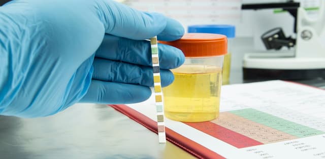 Ý nghĩa của các chỉ số phân tích khi xét nghiệm nước tiểu 10 thông số