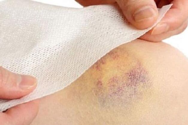 mức độ ảnh hưởng của vỡ mạch máu dưới da