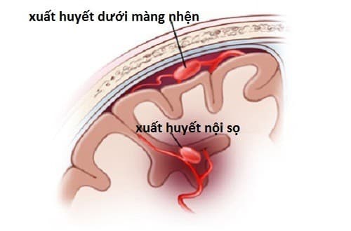 Xuất huyết não có thể gây biến chứng nguy hiểm đe dọa tính mạng
