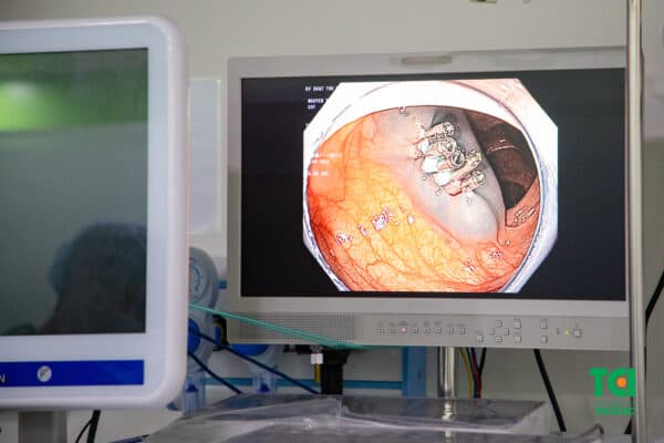 Chi phí cắt polyp đại tràng qua nội soi