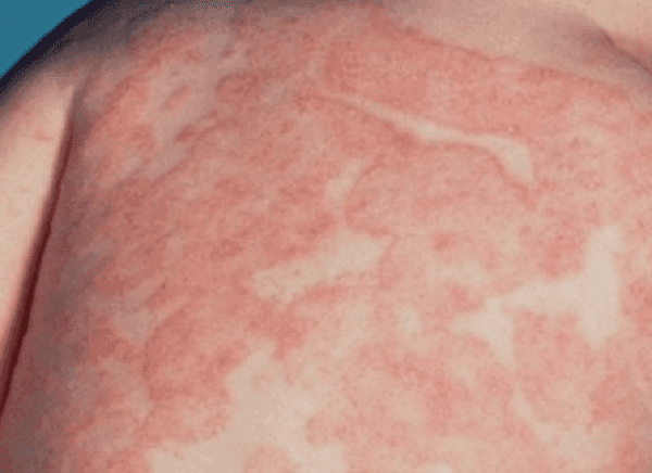 Bị chàm có nguy hiểm không?