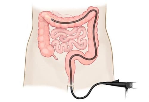 Để nội soi đại tràng, bác sĩ sẽ luồn một ống nội soi qua hậu môn để quan sát toàn bộ đại tràng