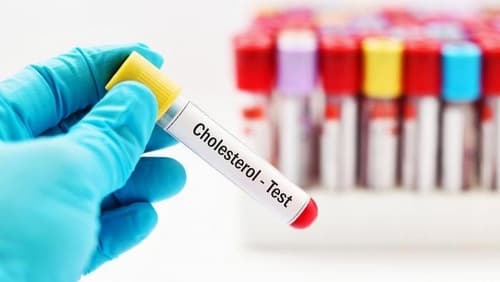 Kiểm tra chỉ số hdl cholesterol trong máu là chỉ định cần thiết trong thăm khám điều trị bệnh