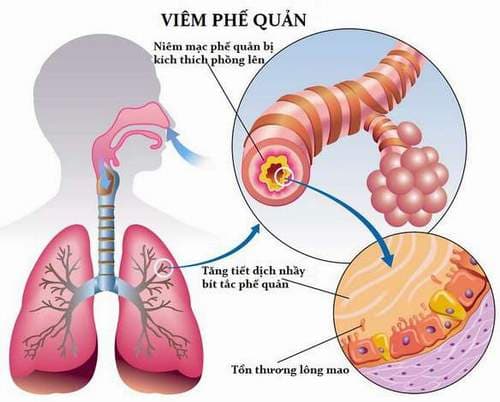 dau-hieu-viem-phe-quan-1