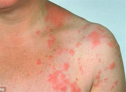 Bệnh giang mai cần được phát hiện sớm và điều trị hiệu quả