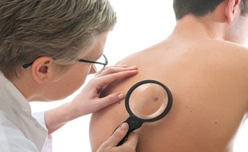 Điều trị ung thư hắc tố như thế nào?