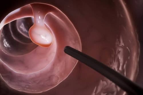 Nội soi giúp phát hiện polyp đại tràng