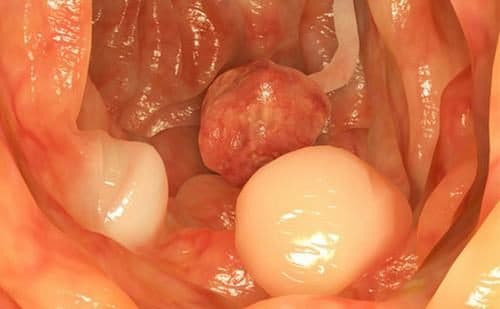 Ung thư đại tràng cũng được phát hiện sớm nhờ nội soi đại tràng