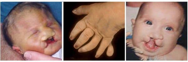 Hội chứng patau hay còn gọi là Trisomy 13 là loại di truyền rối loạn