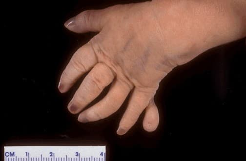 Những em bé mắc hội chứng Patau  thường có trọng lượng sinh bình thường, đầu nhỏ và trán nghiêng, các ngón dư thừa