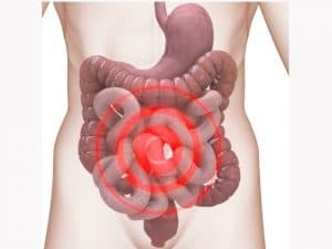 Hội chứng đại tràng kích thích là bệnh lành tính không có tổn thương thực thể ở đại tràng