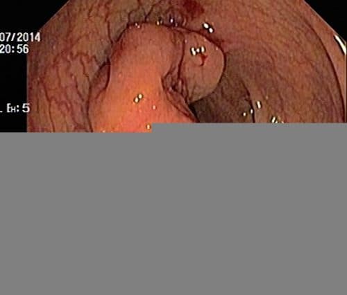 Ung thư đại tràng cũng có thể phát hiện được nhờ nội soi đại tràng