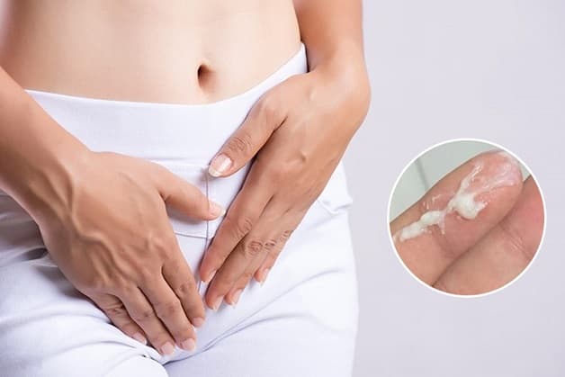 Khí hư màu trắng đục như bột là hiện tượng khiến nhiều chị em lo lắng khi gặp phải