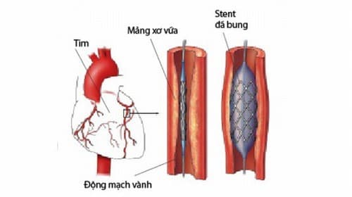 Stent mạch vành được thực hiện trong trường hợp mạch vành bị chít hẹp khiến máu không lưu thông