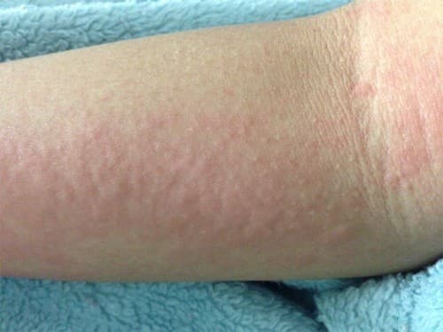 Mẩn ngứa có thể là biểu hiện của nóng gan