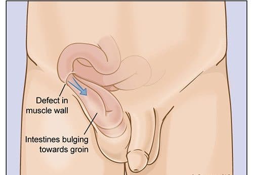 Thoát vị bẹn có thể là do bẩm sinh hoặc mắc phải