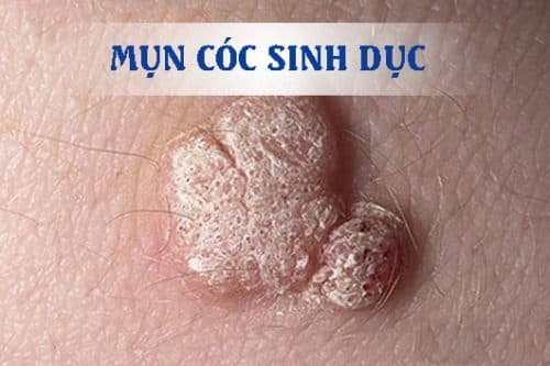 Mụn cóc sinh dục là căn bệnh có thể lây nhiễm qua đường quan hệ tình dục không an toàn và từ mẹ sang con qua đường sinh nở