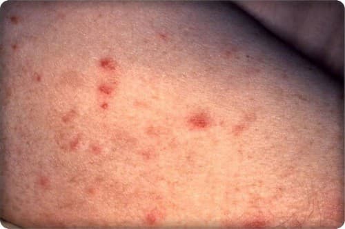 Quan sát bao quy đầu, lỗ niệu đạo da bìu, dương vật,… thấy xuất hiện các chấm đỏ nổi trên bề mặt da.