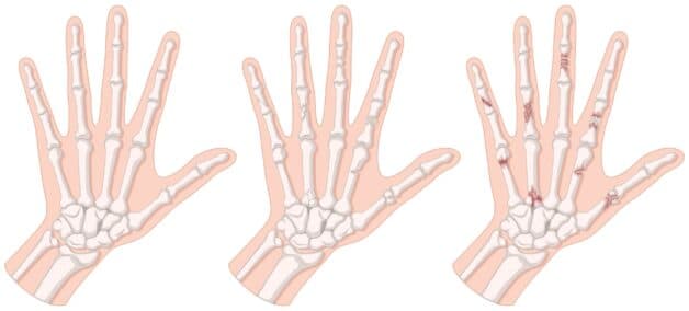 thoai-hoa-khop-ngon-tay