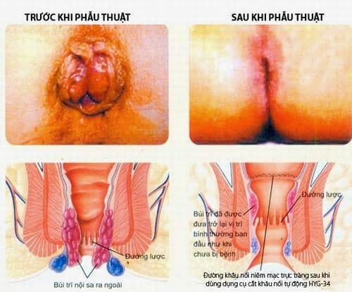 Phẫu thuật trĩ có đau không là thắc mắc của nhiều người trước khi điều trị bệnh