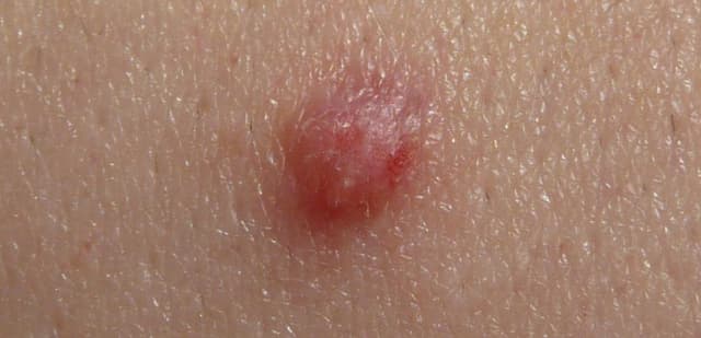 Mụn cóc sinh dục và những điều cần biết