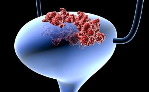 u bang quang ac tinh la gi