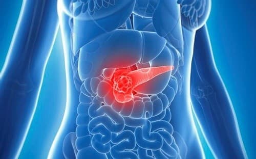 U tụy là gì, có phải là ung thư không cần phải dựa trên những xét nghiệm chuẩn xác