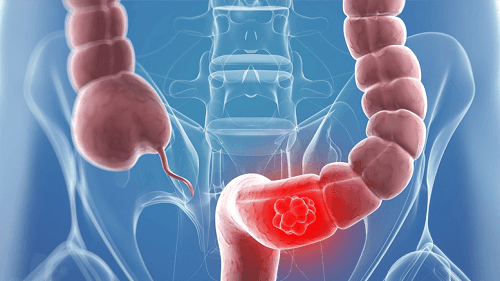 Người dân thủ đô được tầm soát ung thư đại trực tràng miễn phí