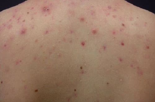 viem-nang-long-o-lung-la-do-dau-1