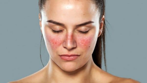  Hiện nay nguyên nhân và cơ chế gây bệnh Lupus ban đỏ chưa được xác định rõ ràng.
