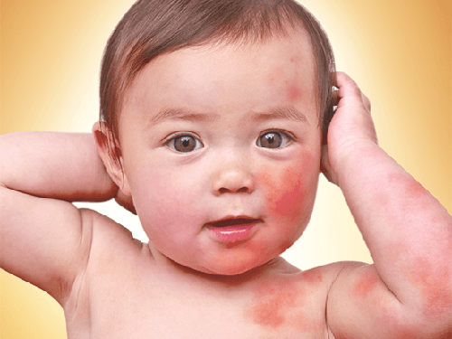 Bé bị dị ứng nổi mẩn đỏ do sức đề kháng yếu và da non