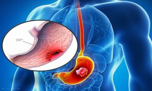 Ung thư dạ dày là khối u ác tính có thể phát triển ở bất cứ phần nào của dạ dày 